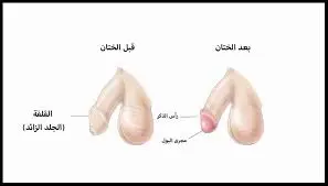 صور الختان قبل وبعد