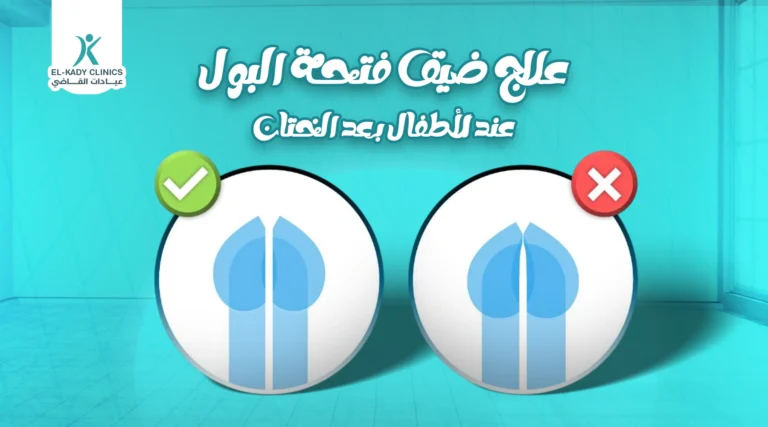 علاج ضيق فتحة البول عند الأطفال بعد الختان