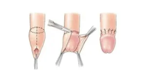ما هو شكل غرز الختان