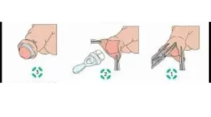 مراحل سقوط حلقة الختان بالصور