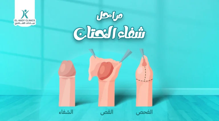 مراحل شفاء الختان بالصور وشكل الختان الصحيح للذكور