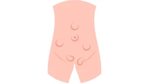 أنواع الفتق عند الأطفال بالصور