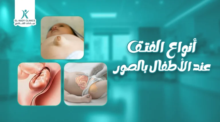 4 أنواع الفتق عند الأطفال بالصور