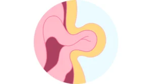 الفتق الإربي عند الرضع بالصور شكل الفتق عند الأطفال