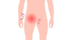 الفتق الفخذي عند الأطفال