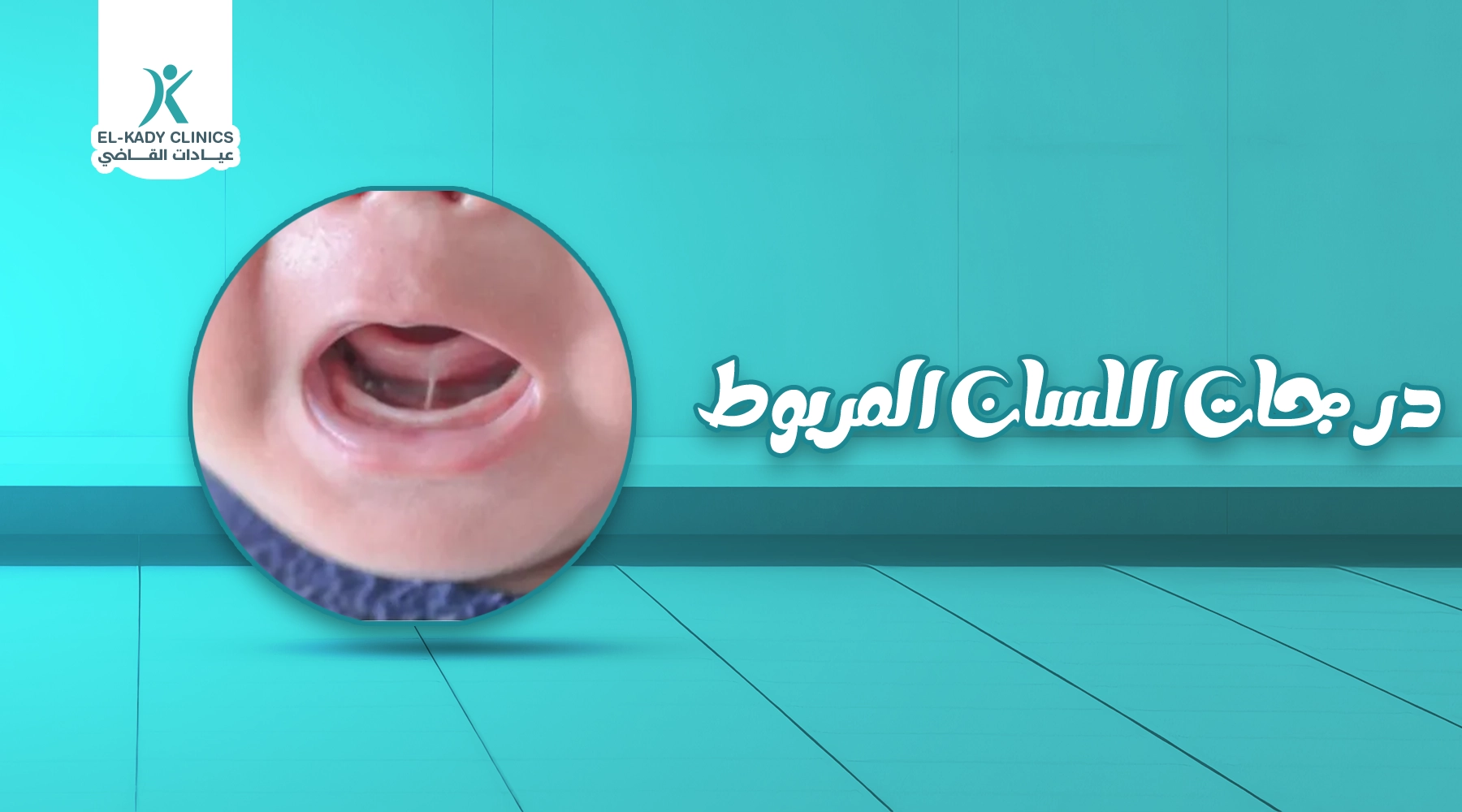 درجات اللسان المربوط: ما هي أنواع اللسان المربوط؟