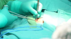 مضاعفات عملية الفتق الإربي عند الأطفال وأعراض فشل عملية الفتق الإربي