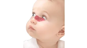 أسباب الوحمات أنواع الوحمات