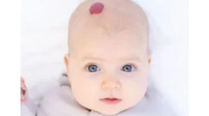 أسباب الوحمة الدموية عند الأطفال