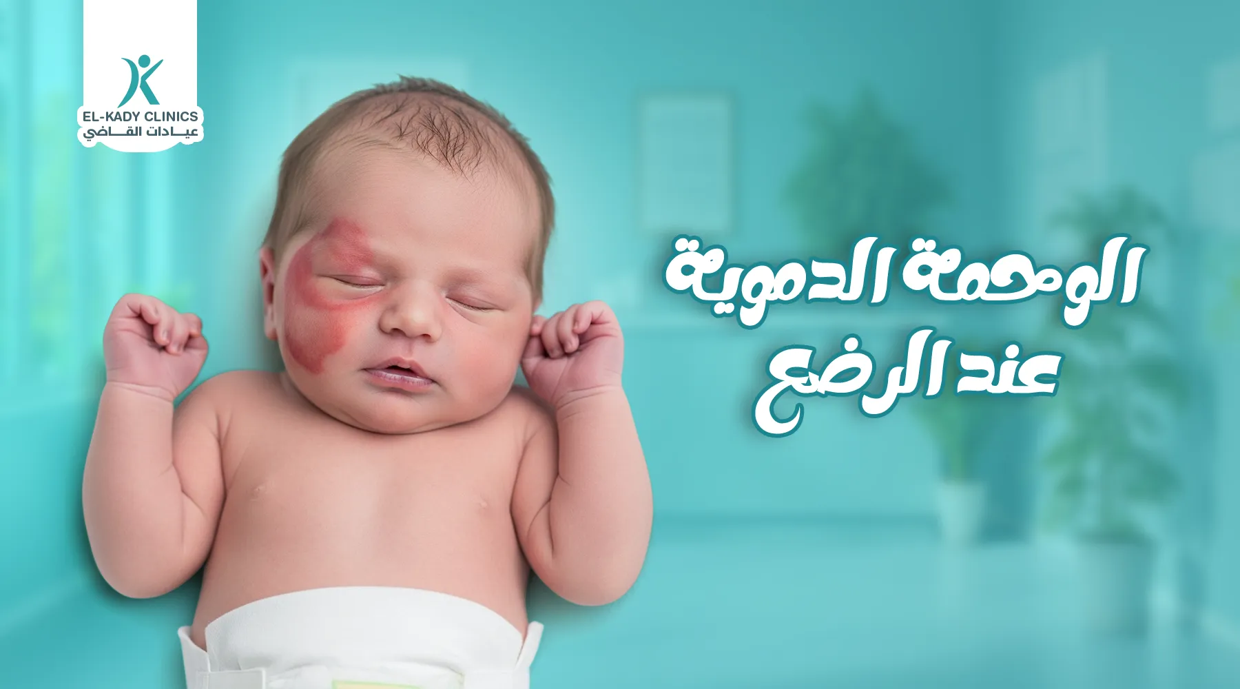 الوحمة الدموية عند الرضع