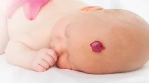 الوحمة الدموية لحديثي الولادة الوحمة الدموية للرضع