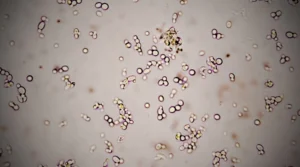 علاج بكتيريا e coli في البول عند الأطفال