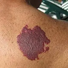 الوحمات النبيذية