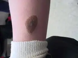 الوحمة الخلقية