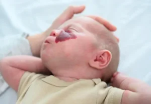 شكل الوحمة الدموية عند الأطفال