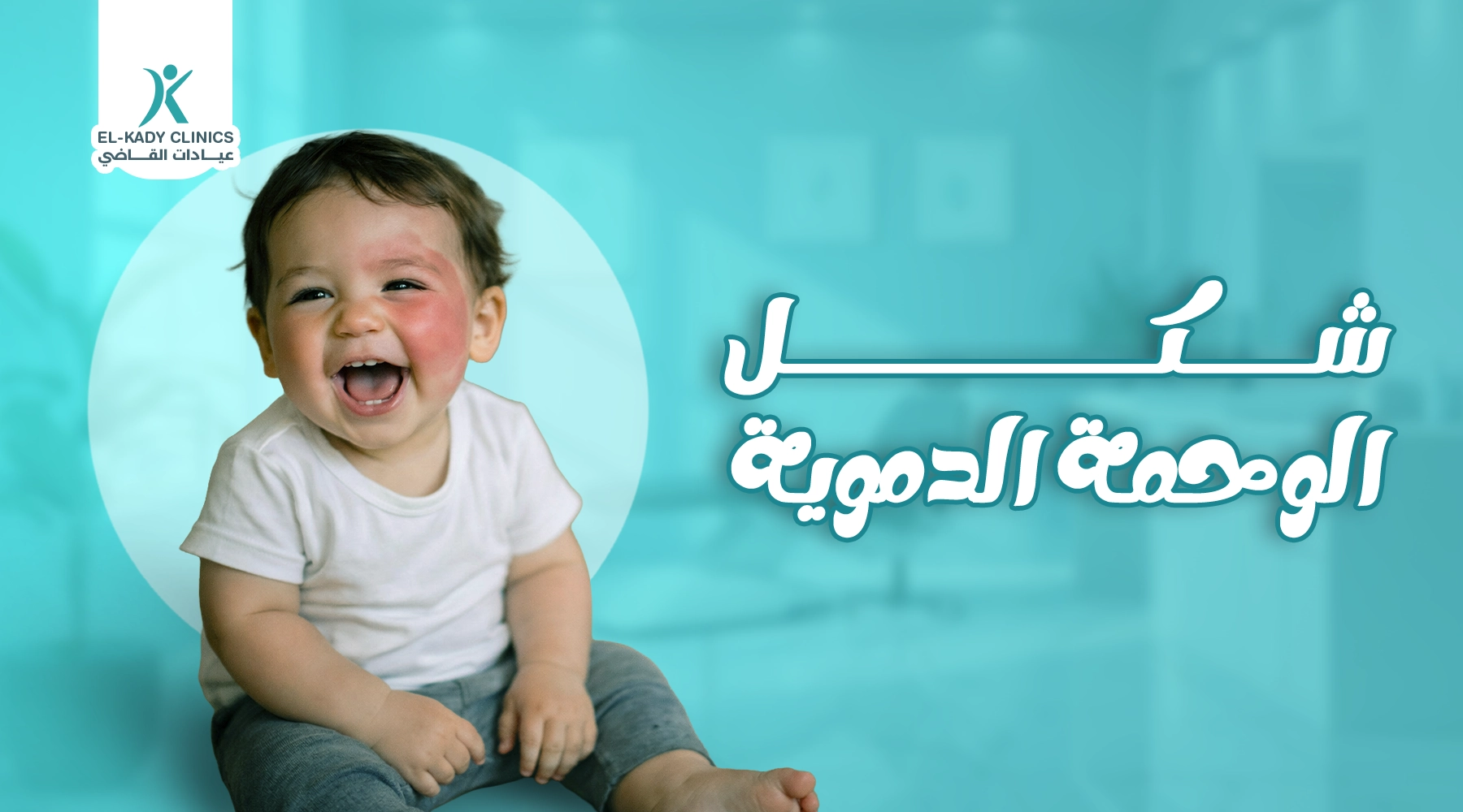 شكل الوحمة الدموية بالصور