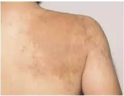 شكل وحمة بيكر