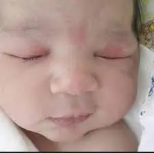 وحمة السلمون