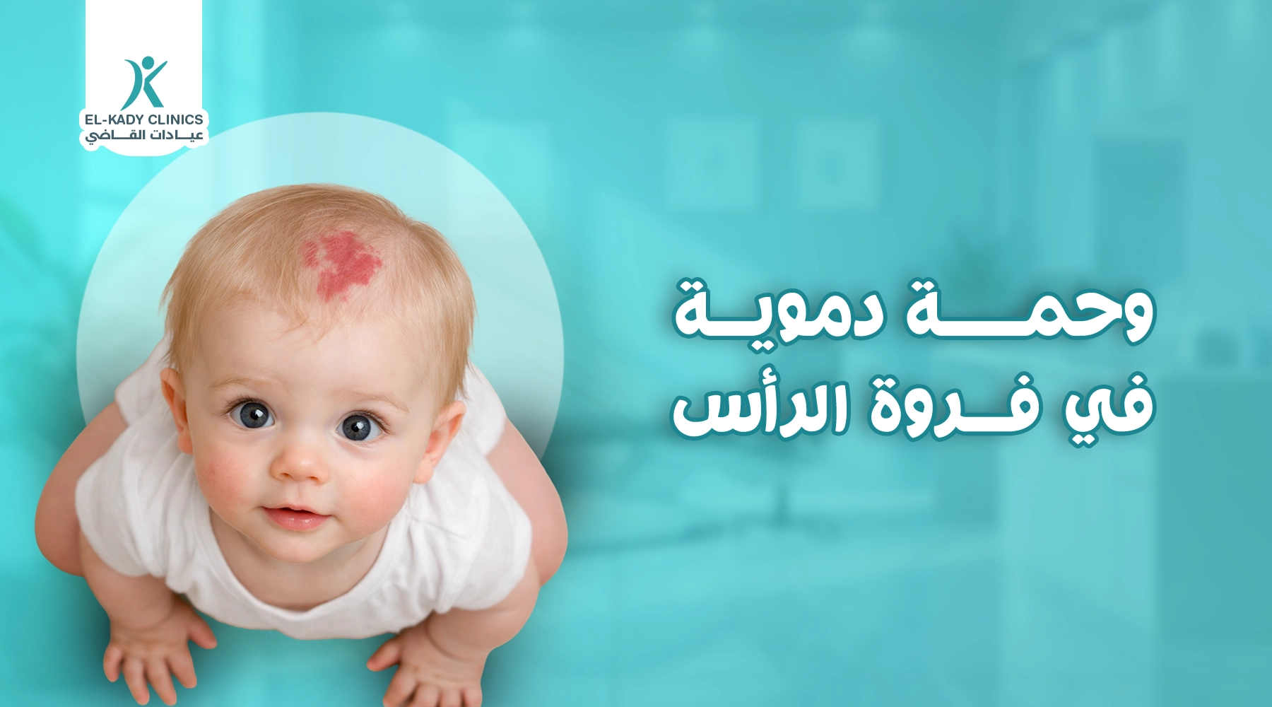 وحمة دموية في فروة الرأس وعلاجها مع الدكتور رضا القاضي