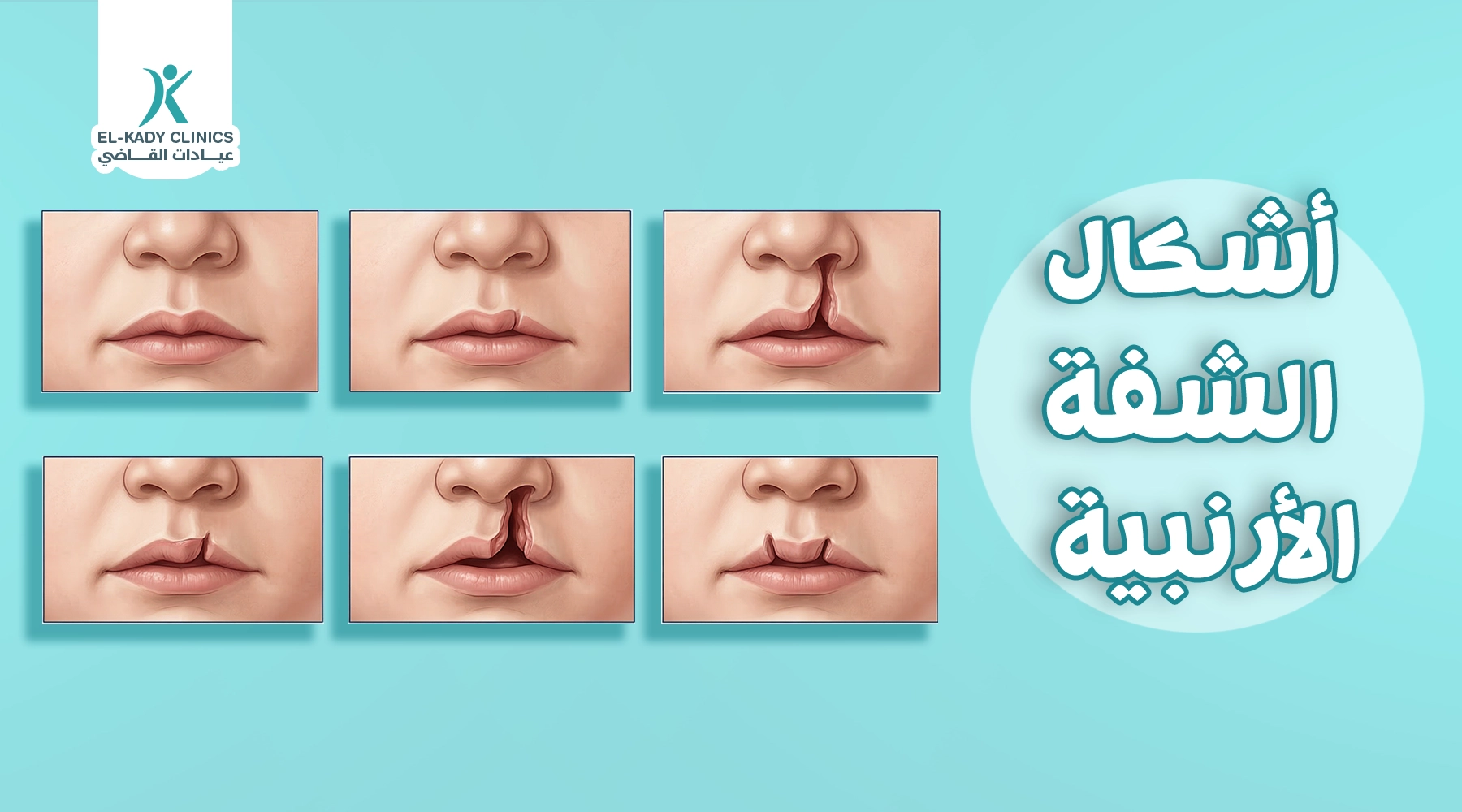 أشكال الشفة الأرنبية وأنواعها