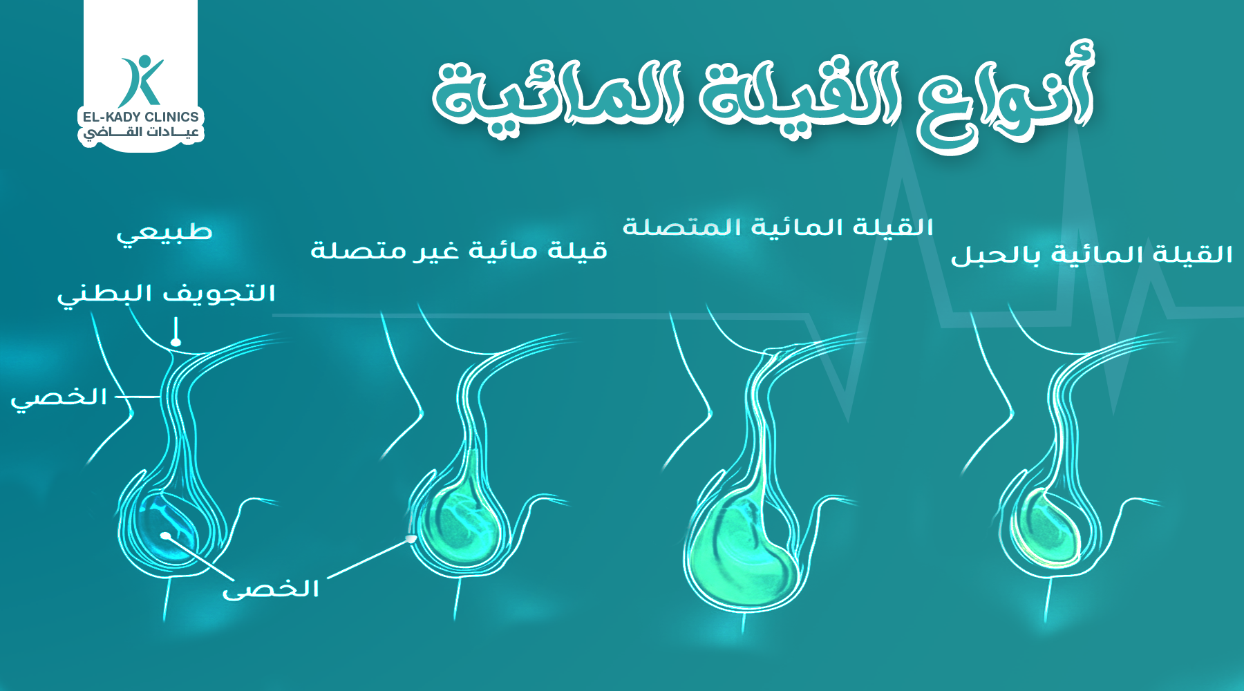 أنواع القيلة المائية عند الأطفال