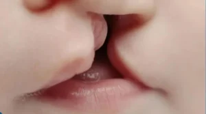 الشفة الأرنبية أحادية الجانب (Unilateral Cleft Lip)