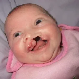 الشفة الأرنبية الكاملة (Complete Cleft Lip)