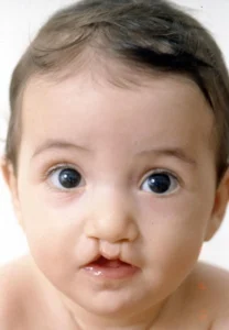 الشفة الأرنبية ثنائية الجانب (Bilateral Cleft Lip)