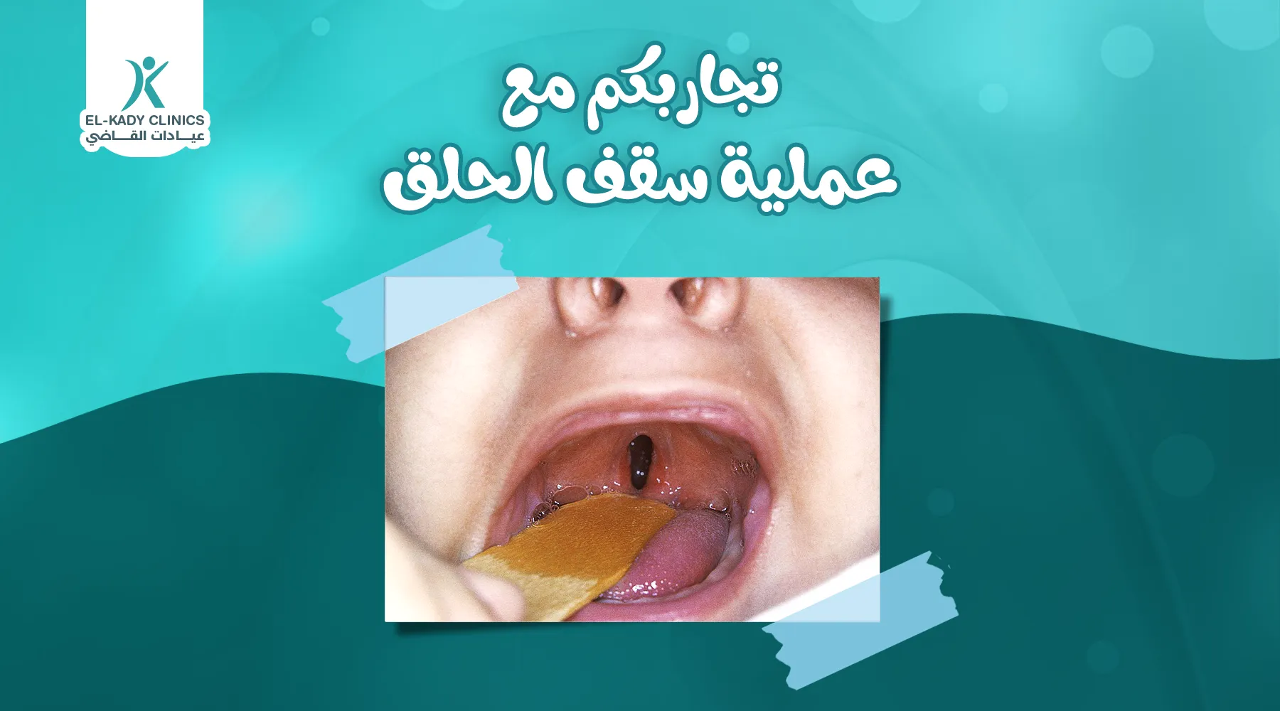 تجاربكم مع عملية سقف الحلق المشقوق مع الدكتور رضا القاضي