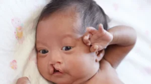 شكل الشفه الارنبيه في السونار الشفة الأرنبية في السونار الرباعي