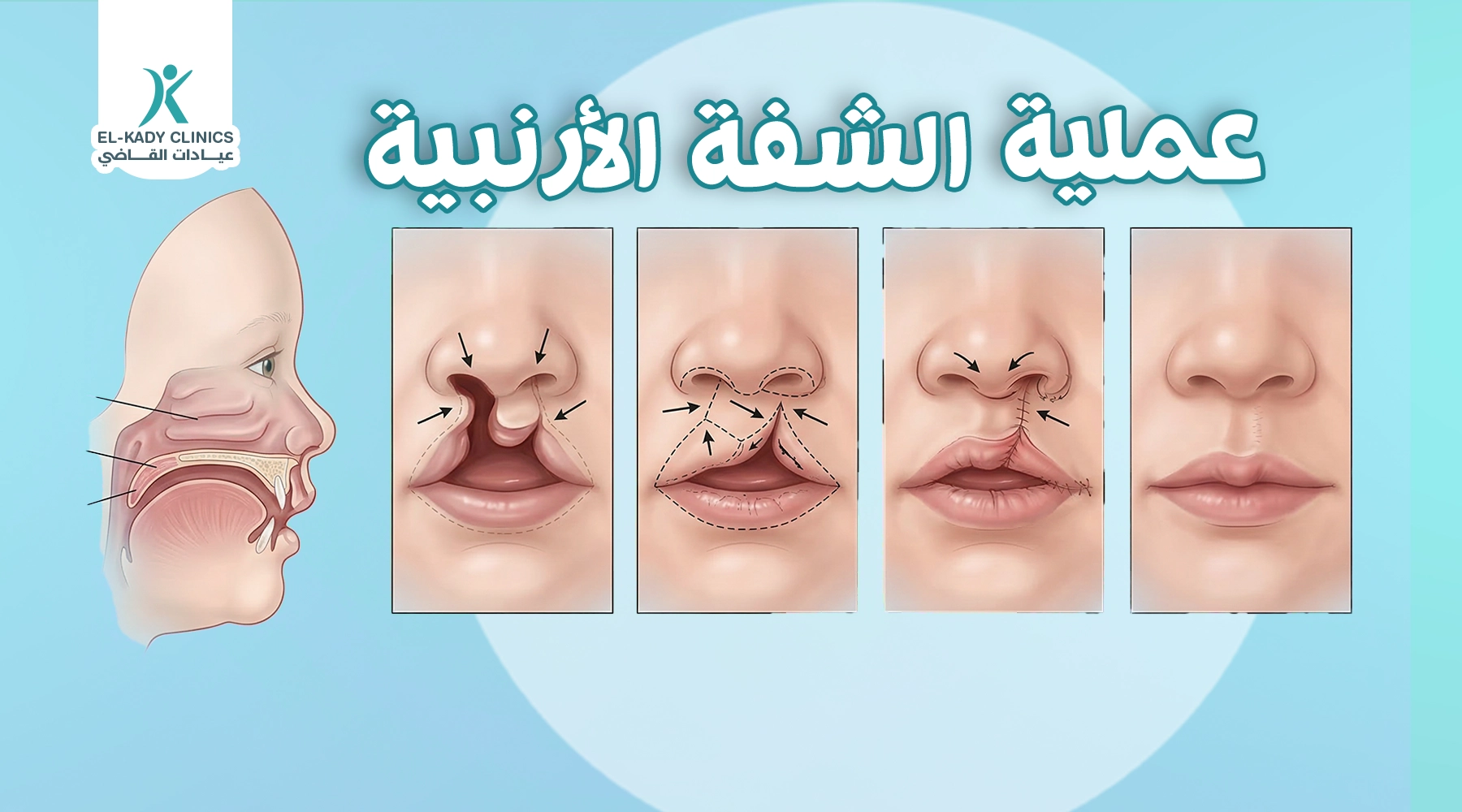 عملية الشفة الأرنبية