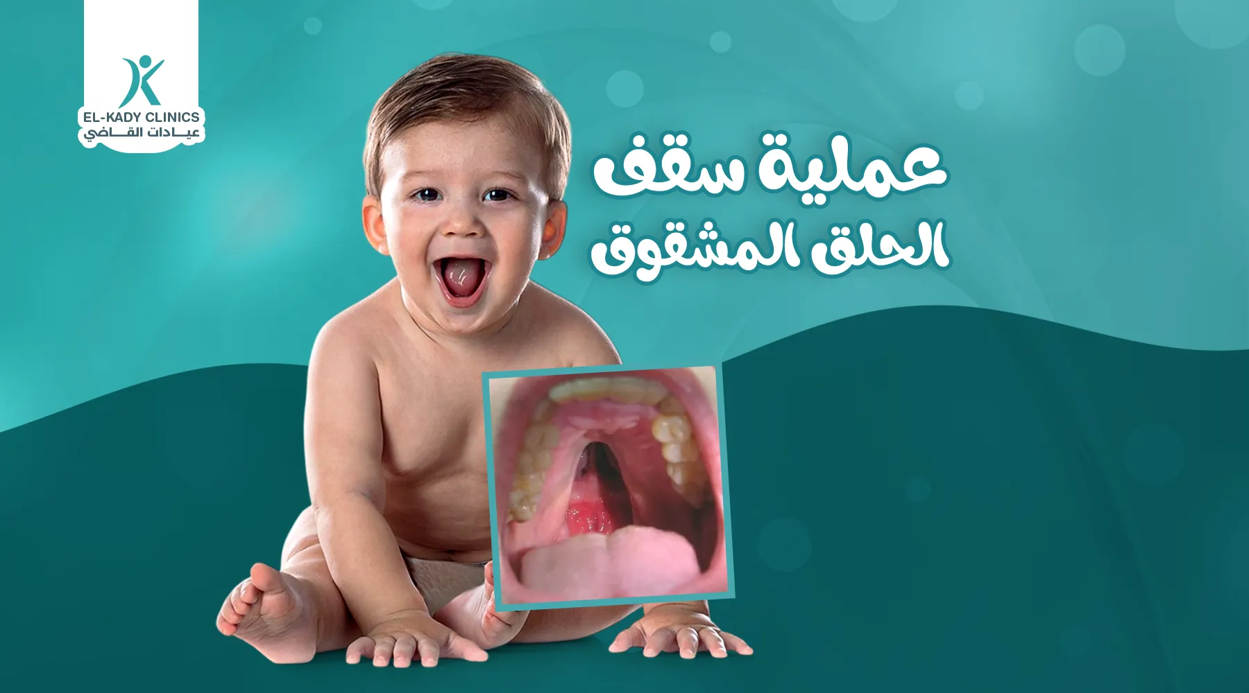 عملية سقف الحلق المشقوق