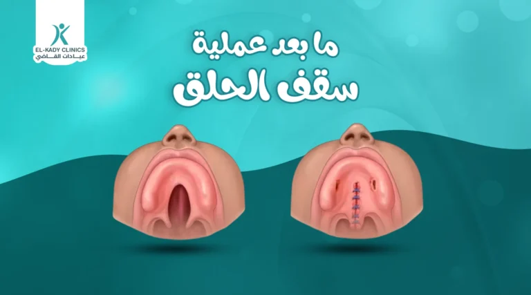 ما بعد عملية سقف الحلق المشقوق وأهم 7 إرشادات