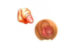 الختان الخاطئ للذكور بالصور