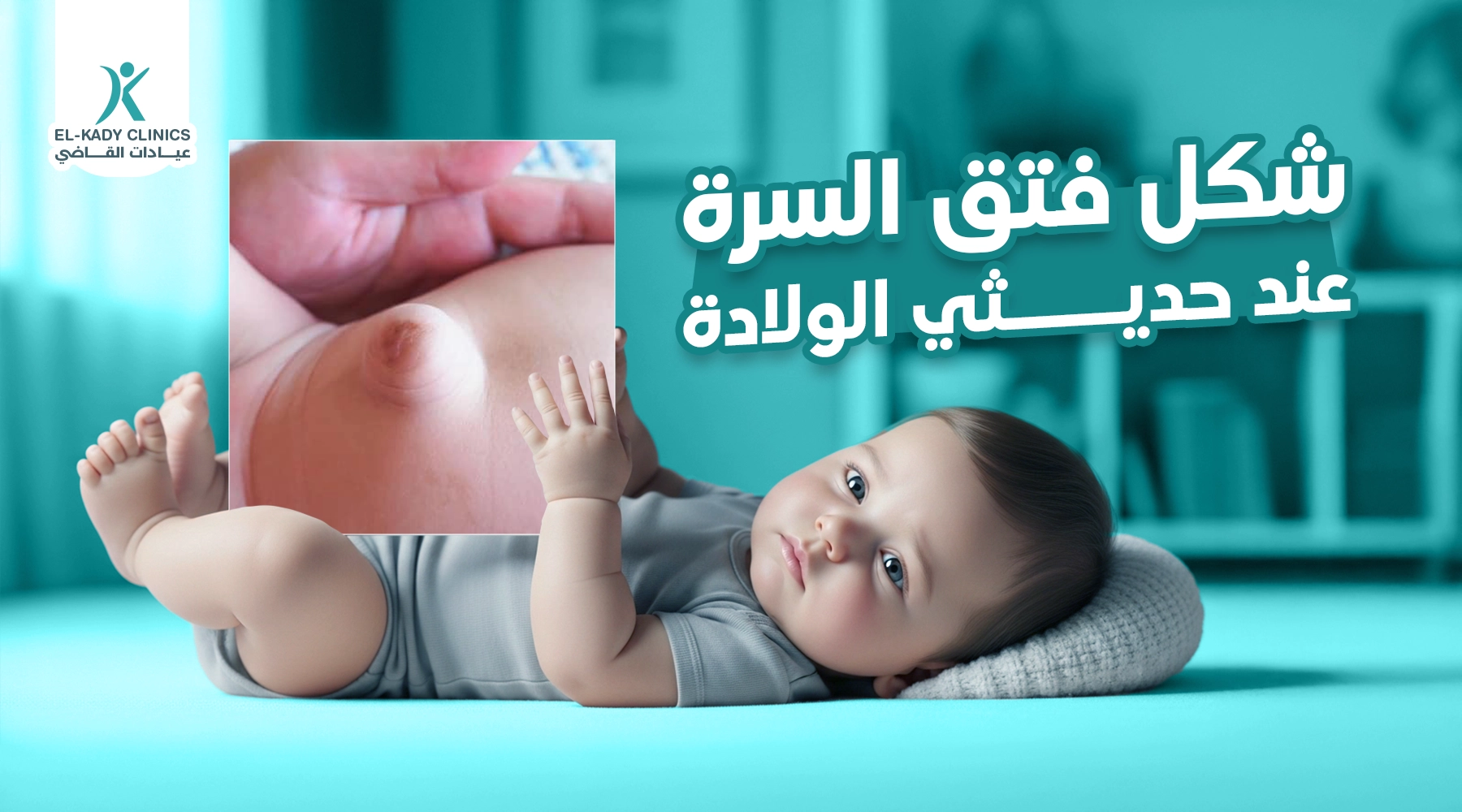 شكل فتق السرة عند حديثي الولادة