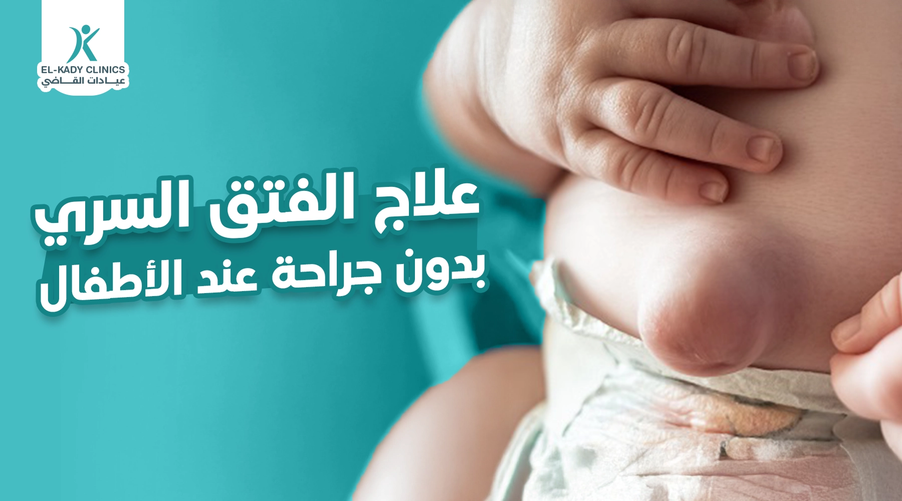 علاج الفتق السري بدون جراحة عند الأطفال