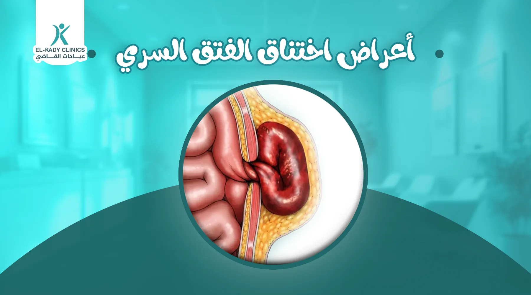 أعراض اختناق الفتق السري