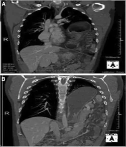 الأشعة المقطعية (CT Scan) بعد الولادة