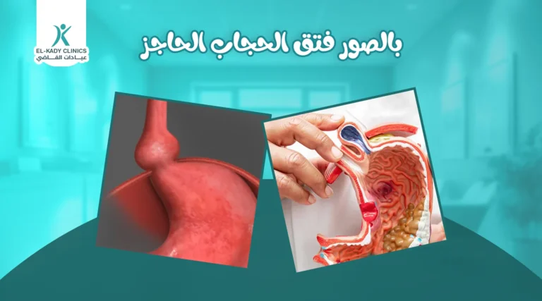 بالصور فتق الحجاب الحاجز عند الأطفال