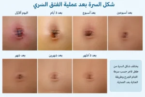 شكل السرة بعد عملية الفتق السري