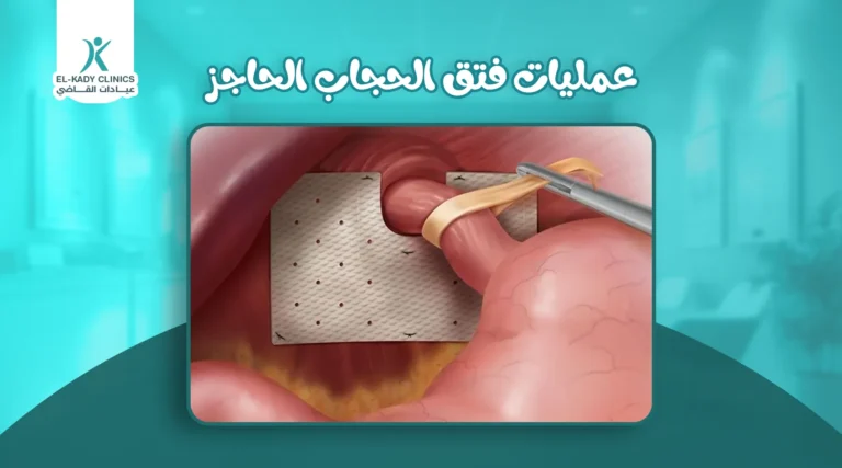 عمليات فتق الحجاب الحاجز عند الأطفال 2026