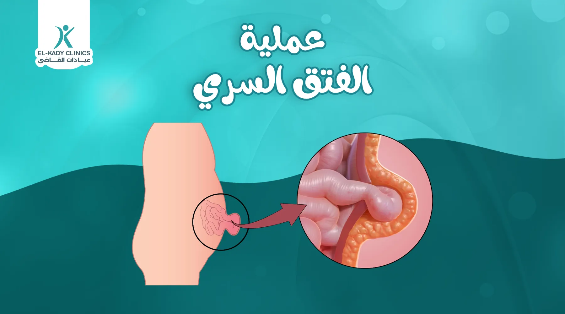 عملية الفتق السري للأطفال