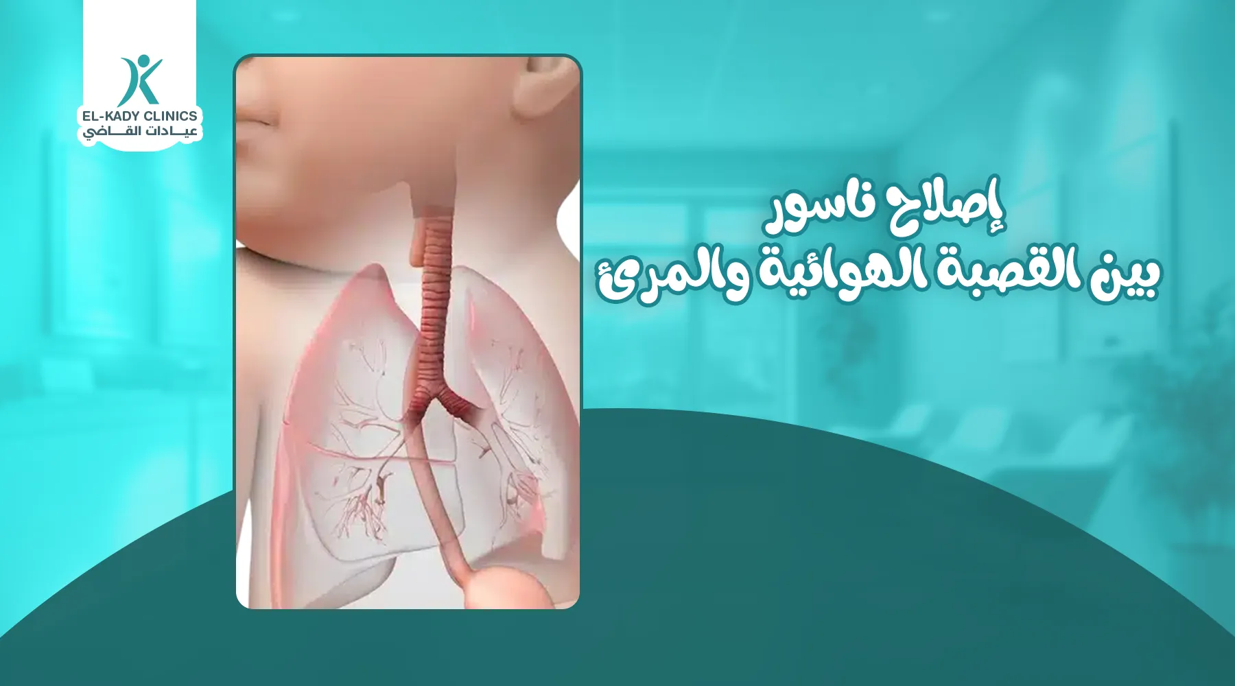 إصلاح ناسور بين القصبة الهوائية والمريء