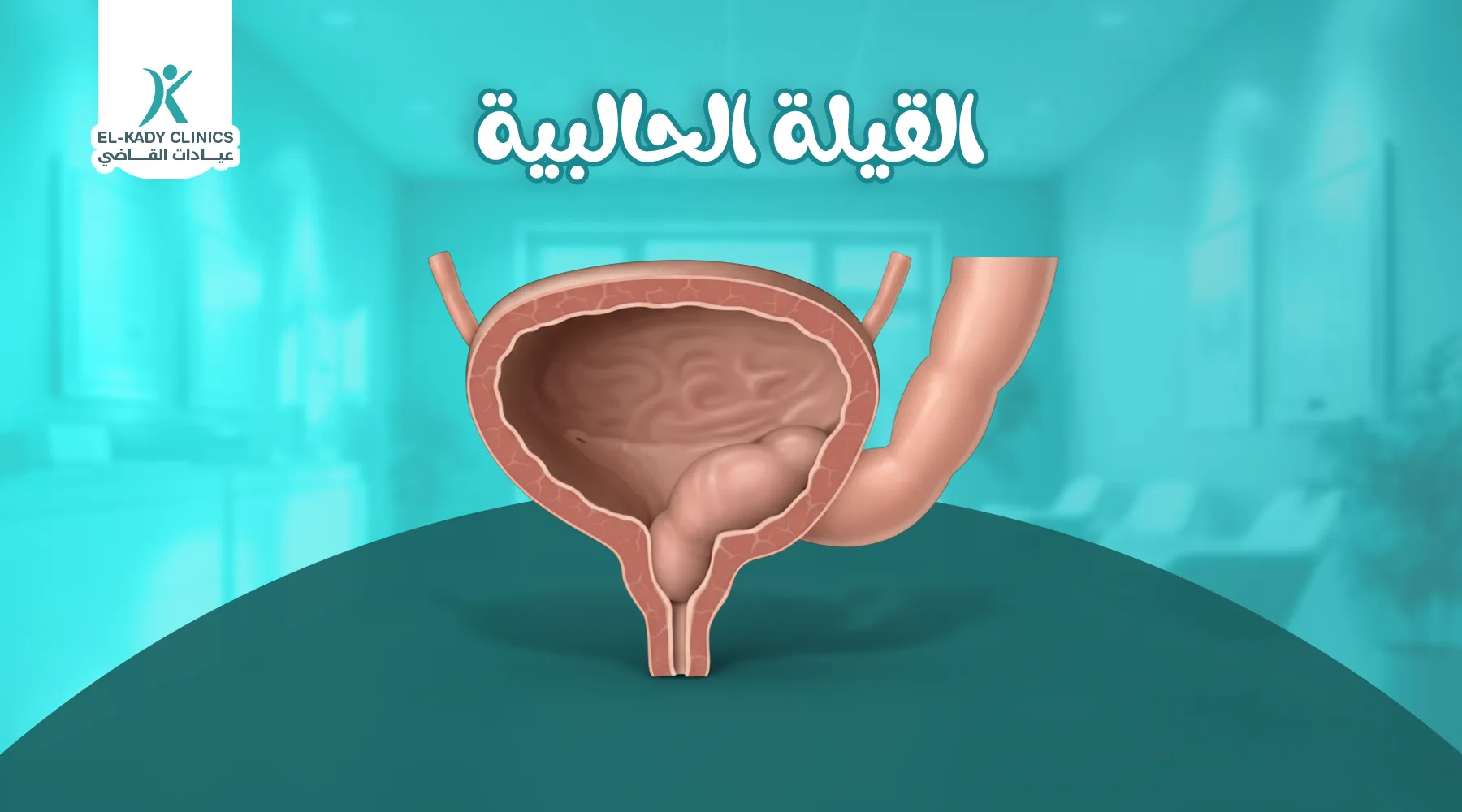 القيلة الحالبية عند الأطفال