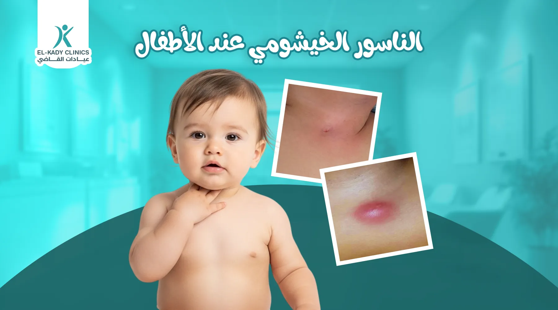 الناسور الخيشومي عند الأطفال