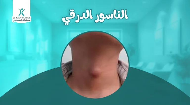 الناسور الدرقي عند الأطفال