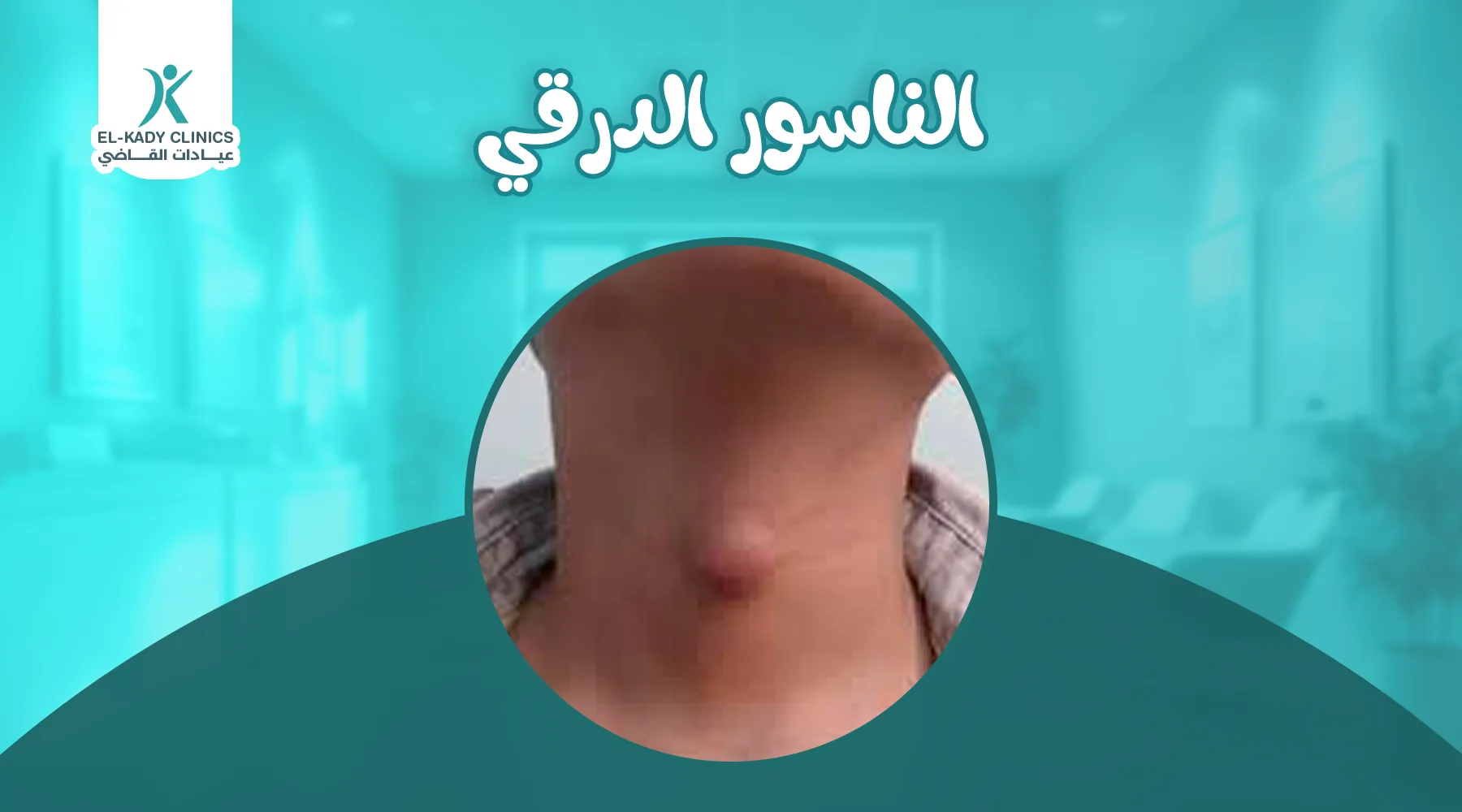 الناسور الدرقي عند الأطفال