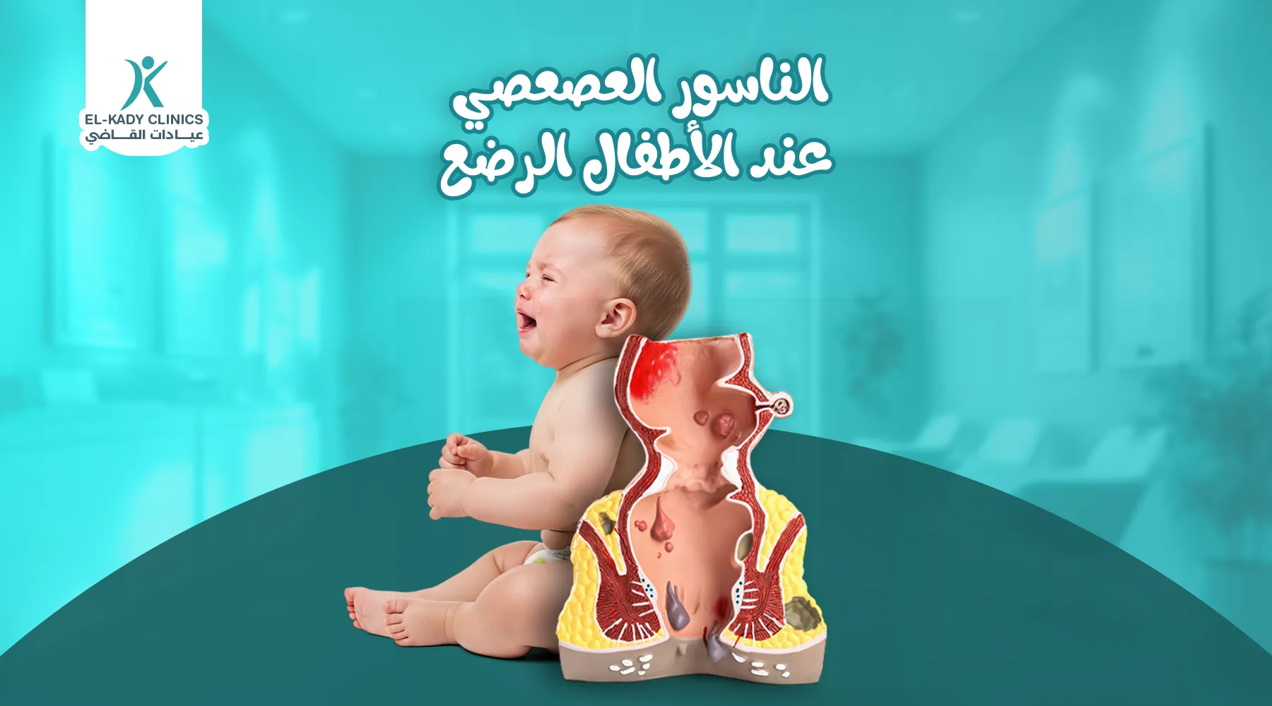 الناسور العصعصي عند الأطفال الرضع وعلاجه