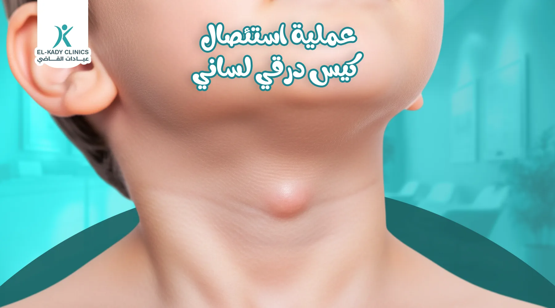 عملية استئصال كيس درقي لساني: عملية سيسترنك
