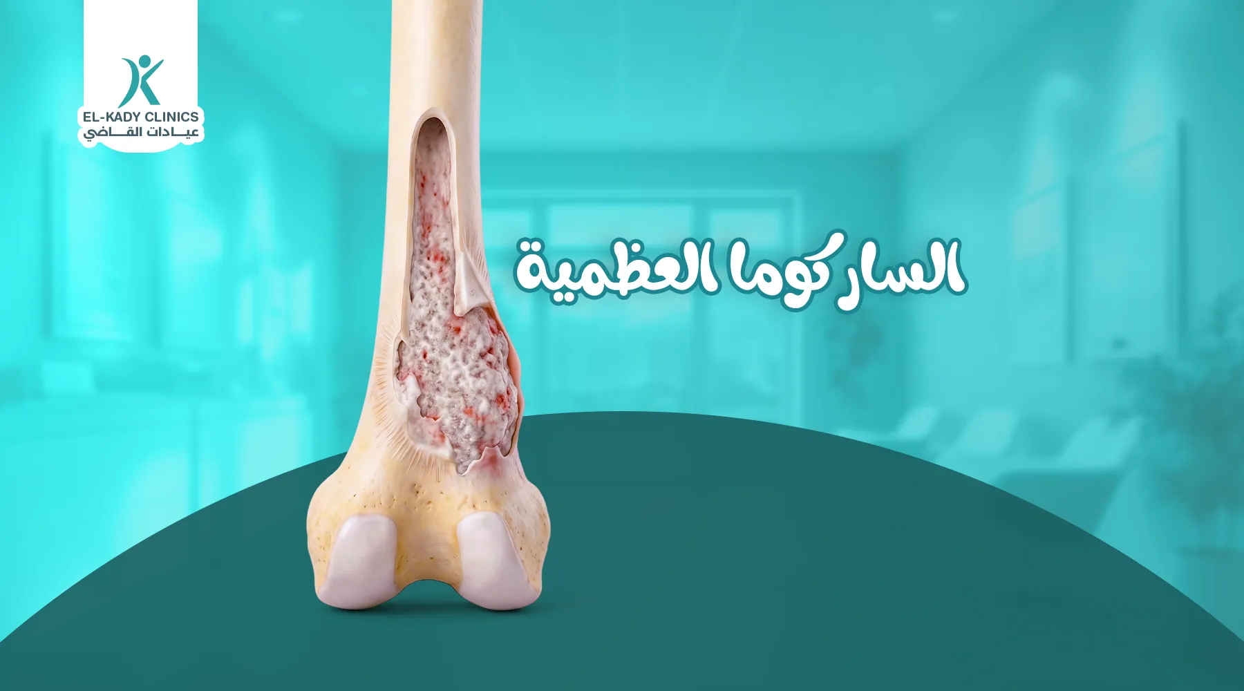 الساركوما العظمية عند الأطفال